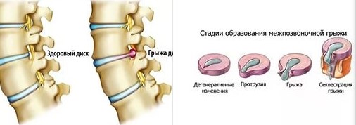 Межпозвоночная грыжа: патогенез, симптомы, диагностика