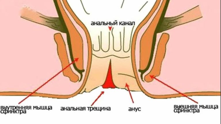 Лечение анальной трещины Лечение анальной трещины