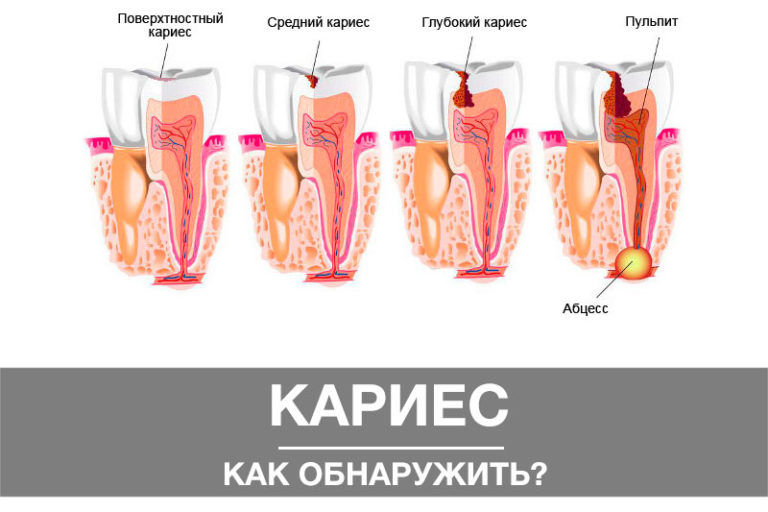 Кариес – как обнаружить? как обнаружить кариес